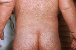 Улаанбурхан өвчний халдварлах чадвар маш өндөр