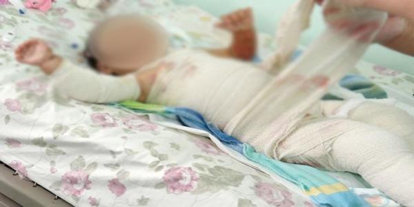 Хоёрт настай хүү цайнд түлэгдэж нас баржээ 