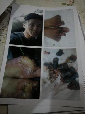 Есөн хуруугаа тайруулсан байлдагч Ерөнхийлөгчид захидал бичив