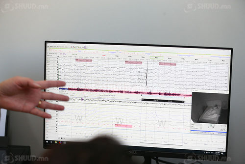 Сэтгэцийн эмгэг 30-54 насны хүн амд хамгийн өндөр үзүүлэлттэй байна 