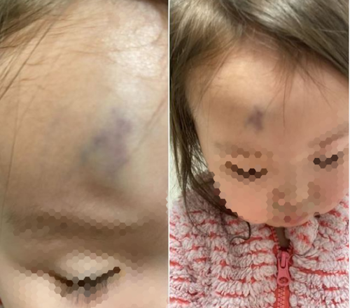 Хоёр настай охины гэмтлийн зэргийг тогтоохоор шинжээч эмч томилжээ