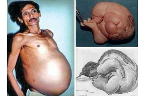 Энэтхэгийн оршин суугч эр 36 жилийн туршид ихрээ гэдсэндээ тээж явжээ